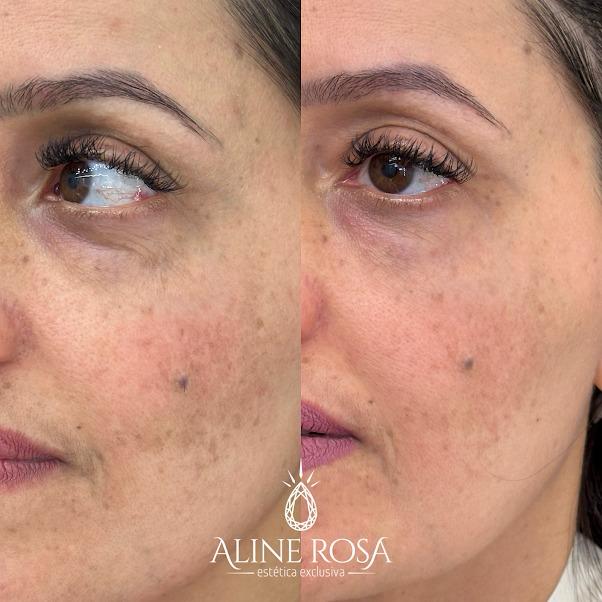 Gerenciamento de Melasma